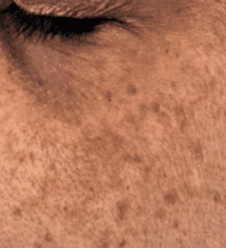 Hyperpigmentation